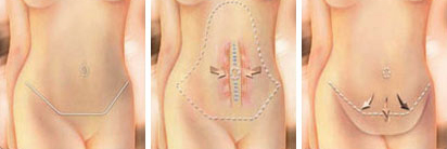 Tummy tuck surgery 