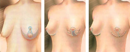 Breast lift surgery in Ontario
