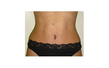  Tummy tuck - After treatment