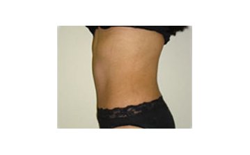  Tummy tuck - After treatment