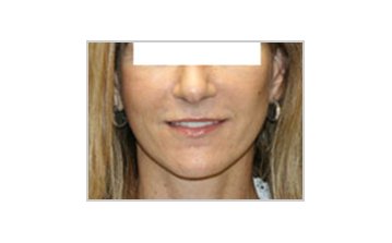 Neck and jowl lift - after treatment
