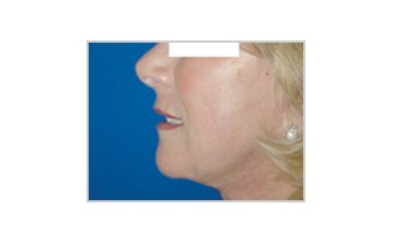 Facelift - After treatment