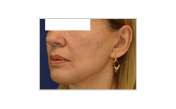 Neck and jowl lift - after treatment