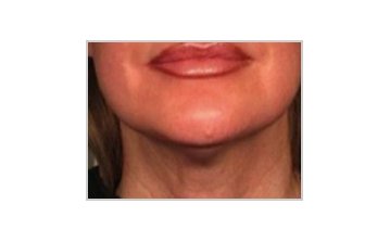 Neck and jowl lift - after treatment