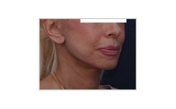 Neck and jowl lift - after treatment