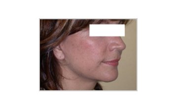 Neck and jowl lift - after treatment