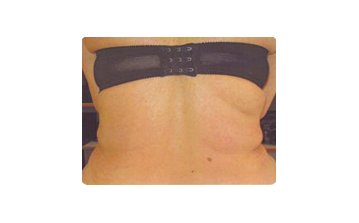 Lipodissolve - After treatment