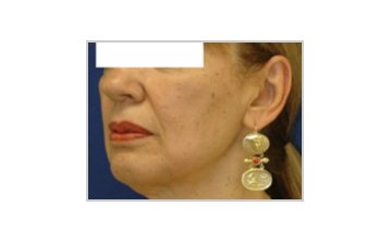 Neck and jowl lift - Before Treatment