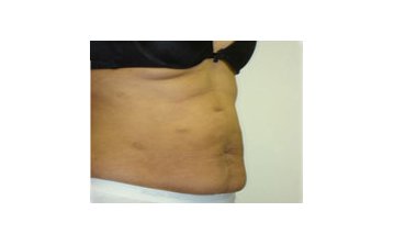 Tummy tuck - Before treatment