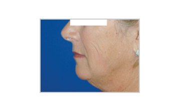 Facelift - Before treatment