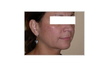 Neck and jowl lift - Before Treatment