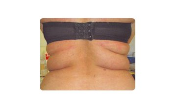Lipodissolve - Before treatment