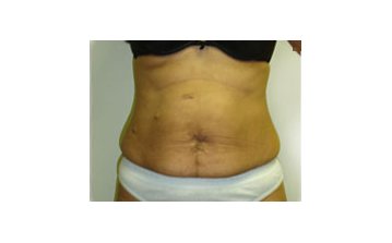 Tummy tuck - Before treatment