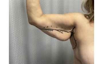 Brachioplasty - Before treatment