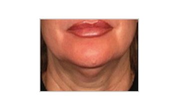 Neck and jowl lift - Before Treatment