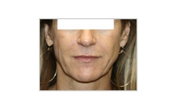 Neck and jowl lift - Before Treatment