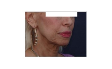 Neck and jowl lift - Before Treatment