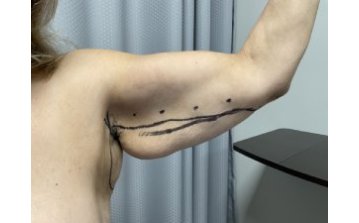 Brachioplasty - Before treatment